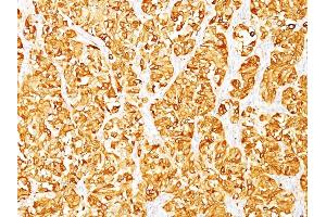 Formalin-fixed, paraffin-embedded human Melanoma stained with MART-1 Monoclonal Antibody (M2-7C10). (MLANA antibody)