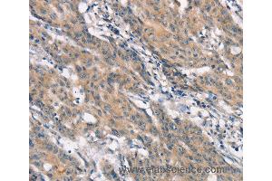 Immunohistochemistry of Human gastric cancer using CRKL Polyclonal Antibody at dilution of 1:25