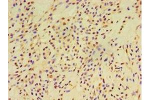 Immunohistochemistry of paraffin-embedded human breast cancer using ABIN7152252 at dilution of 1:100 (EXOC2 antibody  (AA 1-220))