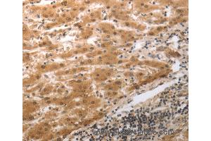 Immunohistochemistry of Human liver cancer using MMP27 Polyclonal Antibody at dilution of 1:40