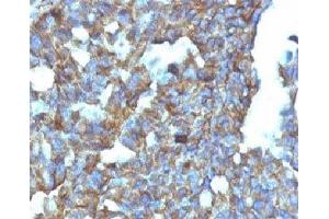 Formalin-fixed, paraffin-embedded human ovarian carcinoma stained with CD99 antibody (MIC2/877). (CD99 antibody)