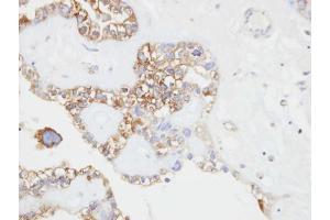 IHC-P Image Immunohistochemical analysis of paraffin-embedded human ovarian cancer, using CD146, antibody at 1:500 dilution. (MCAM antibody  (N-Term))