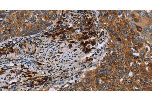 Immunohistochemistry of paraffin-embedded Human cervical cancer using HYAL3 Polyclonal Antibody at dilution of 1:40