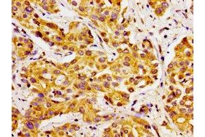 Immunohistochemistry of paraffin-embedded human liver cancer using ABIN7170770 at dilution of 1:100 (CYP27A1 antibody  (AA 290-407))