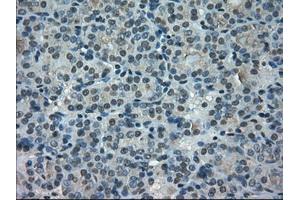 Immunohistochemical staining of paraffin-embedded Carcinoma of thyroid tissue using anti-PORmouse monoclonal antibody. (POR antibody)