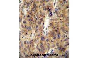 ACF Antibody (C-term) immunohistochemistry analysis in formalin fixed and paraffin embedded human hepatocarcinoma followed by peroxidase conjugation of the secondary antibody and DAB staining. (A1CF antibody  (C-Term))