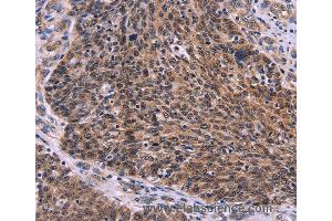 Immunohistochemistry of Human colon cancer using CDC5L Polyclonal Antibody at dilution of 1:30 (CDC5L antibody)