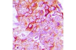 Immunohistochemical analysis of EPHB1/2 staining in human breast cancer formalin fixed paraffin embedded tissue section. (EPHB1/2 antibody)