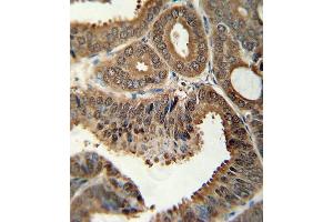 Formalin-fixed and paraffin-embedded human colon carcinoma tissue reacted with ITGA6 Antibody (isoform 2 ) (ABIN389229 and ABIN2839381) , which was peroxidase-conjugated to the secondary antibody, followed by DAB staining. (ITGA6 antibody  (Isoform 2))