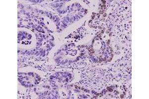 Immunohistochemistry paraffin embedded sections of human colorectal cancer tissue were incubated with SUMO2 monoclonal antibody, clone AT10F1  (1 : 50) for 2 hours at room temperature. (SUMO2 antibody  (AA 1-93))