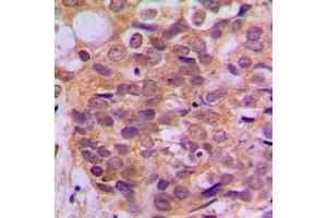 Immunohistochemical analysis of SMAD3 (pS425) staining in human breast cancer formalin fixed paraffin embedded tissue section.