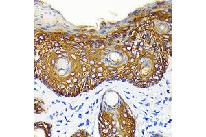 Immunohistochemistry of paraffin-embedded human skin cancer using Cytokeratin 14 (KRT14) (KRT14) Rabbit mAb (ABIN7268091) at dilution of 1:100 (40x lens). (KRT14 antibody)