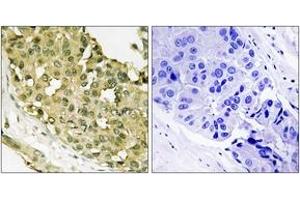 Immunohistochemistry analysis of paraffin-embedded human breast carcinoma, using STMN1 (Phospho-Ser62) Antibody. (Stathmin 1 antibody  (pSer62))