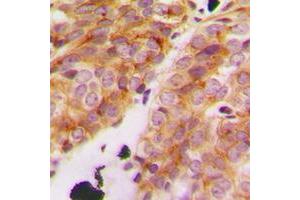 Immunohistochemical analysis of Collagen 11 alpha 1 staining in human breast cancer formalin fixed paraffin embedded tissue section. (COL11A1 antibody  (Center))