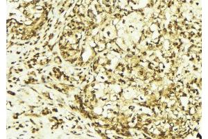ABIN6267618 at 1/100 staining Human breast cancer tissue by IHC-P. (PKC delta antibody  (pTyr313))