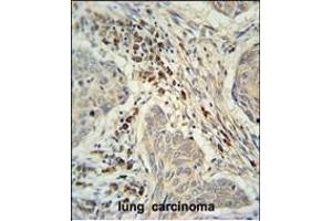 C19orf50 Antibody (Center) (ABIN653085 and ABIN2842681) immunohistochemistry analysis in formalin fixed and paraffin embedded human lung carcinoma followed by peroxidase conjugation of the secondary antibody and DAB staining. (C19orf50 antibody  (AA 59-85))