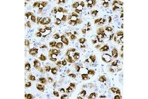 Immunohistochemical analysis of H-Ras staining in human gastric cancer formalin fixed paraffin embedded tissue section. (HRAS antibody)