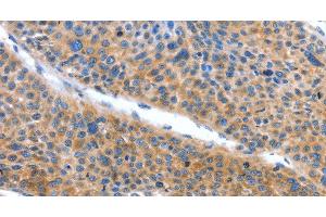 Immunohistochemistry of paraffin-embedded Human liver cancer tissue using ARL11 Polyclonal Antibody at dilution 1:50 (ARL11 antibody)