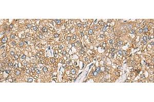 Immunohistochemistry of paraffin-embedded Human liver cancer tissue using CHKA Polyclonal Antibody at dilution of 1:35(x200)