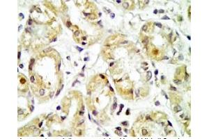 Human stomach cancer tissue was stained by rabbit Anti-Spexin prepro (36-58)  Antibody (Spexin antibody  (Preproprotein))