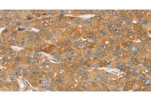 Immunohistochemistry of paraffin-embedded Human liver cancer using TPD54 Polyclonal Antibody at dilution of 1:35 (TPD52L2 antibody)