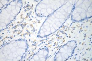 Immunohistochemistry was performed on paraffin-embedded human sigmoid colon carcinoma using p53 antibody (ABIN7800686), 1:200). (Recombinant p53 antibody)