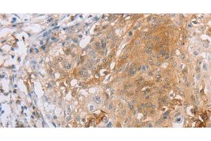 Immunohistochemistry of paraffin-embedded Human cervical cancer tissue using CD85d Polyclonal Antibody at dilution 1:30