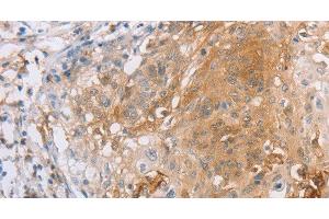 Immunohistochemistry of paraffin-embedded Human cervical cancer tissue using CD85d Polyclonal Antibody at dilution 1:30 (LILRB2 antibody)
