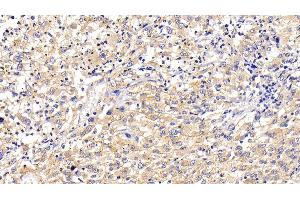 Detection of LAMP2 in Human Liver cancer Tissue using Polyclonal Antibody to Lysosomal Associated Membrane Protein 2 (LAMP2)