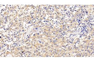 Detection of LAMP2 in Human Liver cancer Tissue using Polyclonal Antibody to Lysosomal Associated Membrane Protein 2 (LAMP2) (LAMP2 antibody  (AA 193-375))