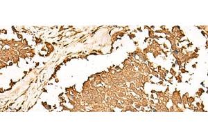 Immunohistochemistry of paraffin-embedded Human lung cancer tissue using PWP1 Polyclonal Antibody at dilution of 1:70(x200)