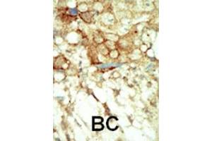 Formalin-fixed and paraffin-embedded human cancer tissue reacted with the primary antibody, which was peroxidase-conjugated to the secondary antibody, followed by DAB staining. (Ret Proto-Oncogene antibody  (C-Term))