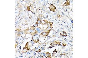 Immunohistochemistry of paraffin-embedded human lung cancer using MMP7 Rabbit pAb (ABIN3021102, ABIN3021103, ABIN3021104, ABIN1513214 and ABIN6213952) at dilution of 1:150 (40x lens). (MMP7 antibody  (AA 18-267))