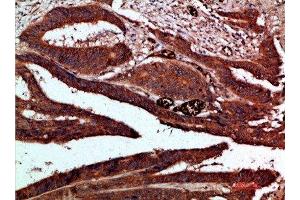 Immunohistochemical analysis of paraffin-embedded human-colon-cancer, antibody was diluted at 1:200 (CDK6 antibody  (AA 280-325))