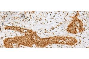 Immunohistochemistry of paraffin-embedded Human esophagus cancer tissue using GOLGA7 Polyclonal Antibody at dilution of 1:40(x200) (Golgin A7 antibody)