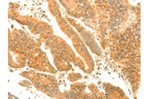 The image on the left is immunohistochemistry of paraffin-embedded Human colon cancer tissue using ABIN7131139(SOCS6 Antibody) at dilution 1/35, on the right is treated with fusion protein. (SOCS6 antibody)
