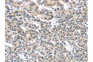 The image on the left is immunohistochemistry of paraffin-embedded Human liver cancer tissue using ABIN7131349(THSD1 Antibody) at dilution 1/25, on the right is treated with fusion protein. (THSD1 antibody)
