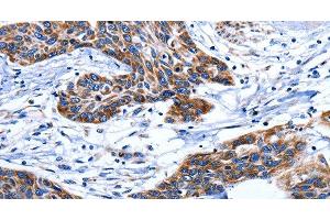 Immunohistochemistry of paraffin-embedded Human esophagus cancer tissue using AQP8 Polyclonal Antibody at dilution 1:75 (Aquaporin 8 antibody)