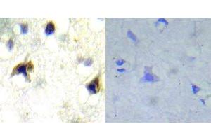 Immunohistochemical analysis of paraffin- embedded human brain carcinoma tissue using PDGFR beta (Ab-751) antibody (E022033). (PDGFRB antibody)