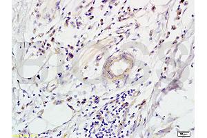 Formalin-fixed and paraffin-embedded human colon carcinoma labeled with Rabbit Anti-CD118 Polyclonal Antibody (ABIN686827), Unconjugated 1:200 followed by conjugation to the secondary antibody and DAB staining (LIFR antibody  (AA 451-580))