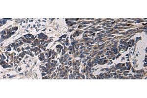 Immunohistochemistry of paraffin-embedded Human colorectal cancer tissue using CCNI Polyclonal Antibody at dilution of 1:65(x200) (Cyclin I antibody)