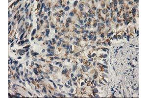 Immunohistochemical staining of paraffin-embedded Carcinoma of Human lung tissue using anti-PNMT mouse monoclonal antibody. (PNMT antibody)