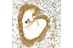 Immunohistochemistry of paraffin-embedded human adenomyosis using RAB27A Antibody (ABIN5970998) at dilution of 1/200 (40x lens). (RAB27A antibody)