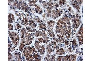 Immunohistochemical staining of paraffin-embedded Carcinoma of liver tissue using anti-PPME1mouse monoclonal antibody. (PPME1 antibody)
