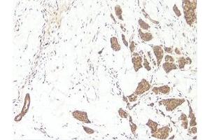 This antibody stained formalin-fixed, paraffin-embedded sections of human breast invasive ductal carcinoma.