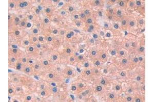 IHC-P analysis of Human Liver cancer Tissue, with DAB staining.