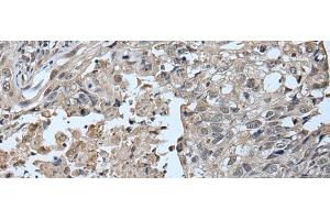 Immunohistochemistry of paraffin-embedded Human lung cancer tissue using UBR2 Polyclonal Antibody at dilution of 1:55(x200) (UBR2 antibody)