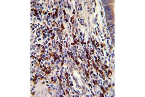 Formalin-fixed and paraffin-embedded human colon carcinoma with CNOT8 Antibody (C-term), which was peroxidase-conjugated to the secondary antibody, followed by DAB staining. (CNOT8 antibody  (C-Term))