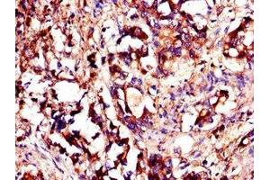 Immunohistochemistry of paraffin-embedded human gastric cancer using ABIN7174080 at dilution of 1:100