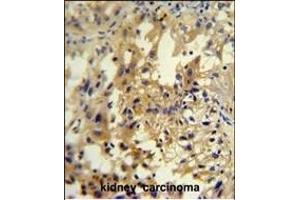 U antibody (C-term) (ABIN654948 and ABIN2844589) immunohistochemistry analysis in formalin fixed and paraffin embedded human kidney carcinoma followed by peroxidase conjugation of the secondary antibody and DAB staining. (UPP2 antibody  (C-Term))